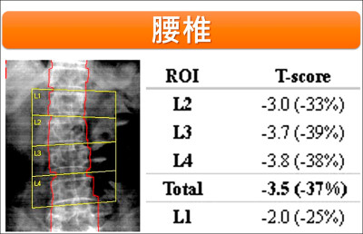 跌倒骨折難補救 骨鬆無症狀 避免隱形殺手找上門