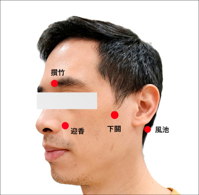 三叉神經痛 中藥＋針灸緩解